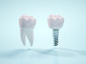 インプラントの特徴と賠償実務におけるハードル